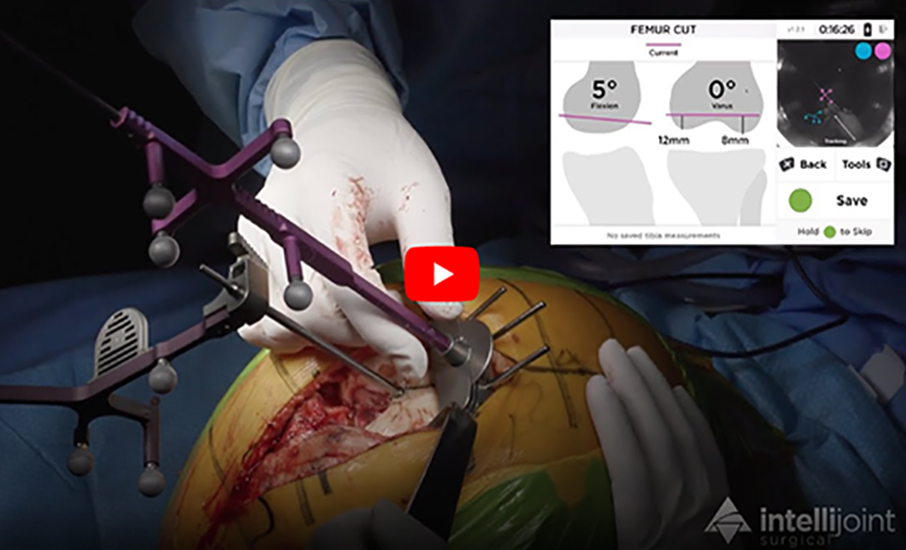 Intellijoint KNEE Smart Navigation Delivers Real-time Measurements for TKA